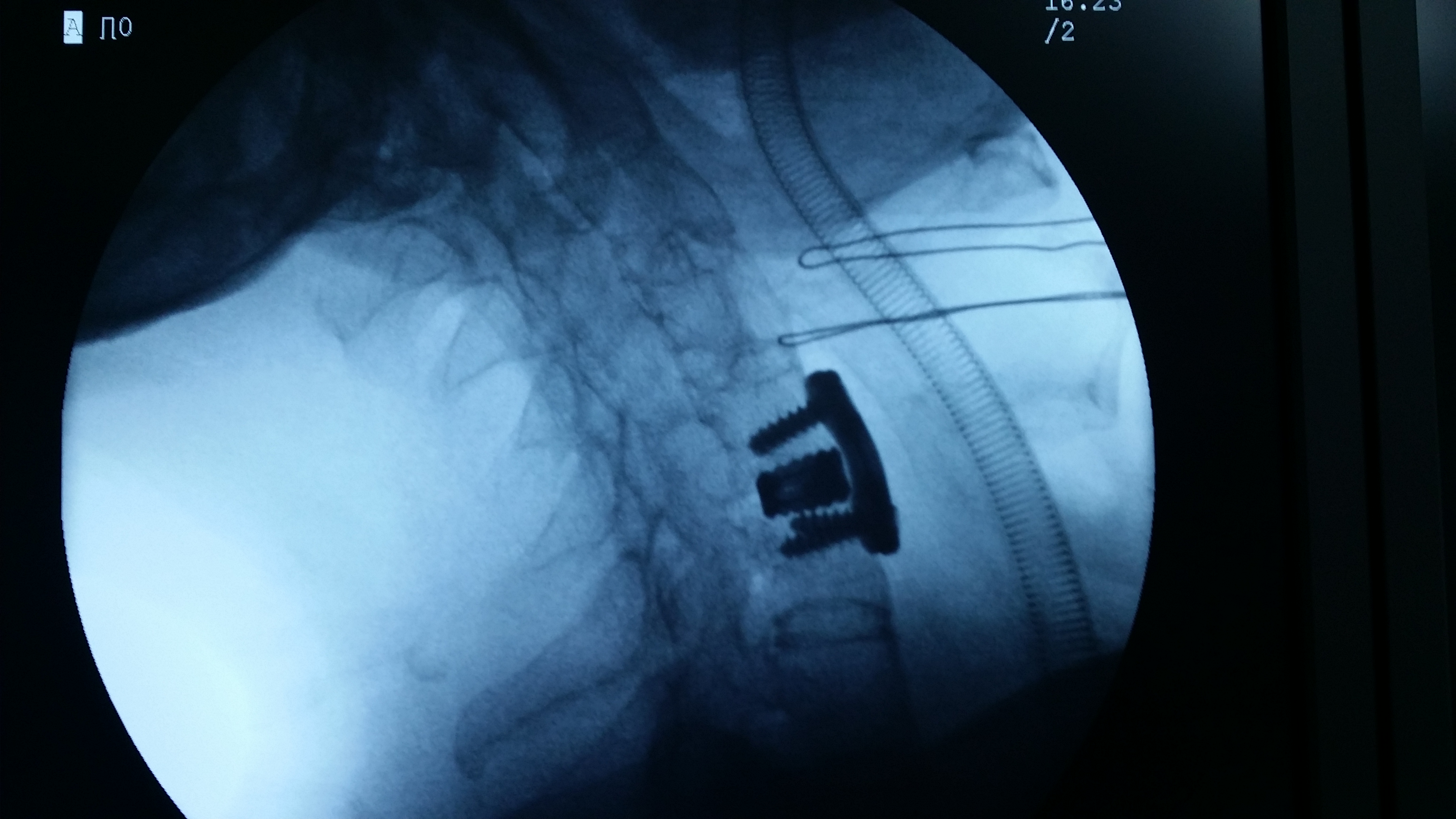 术中颈椎侧位片 术中颈椎侧位片