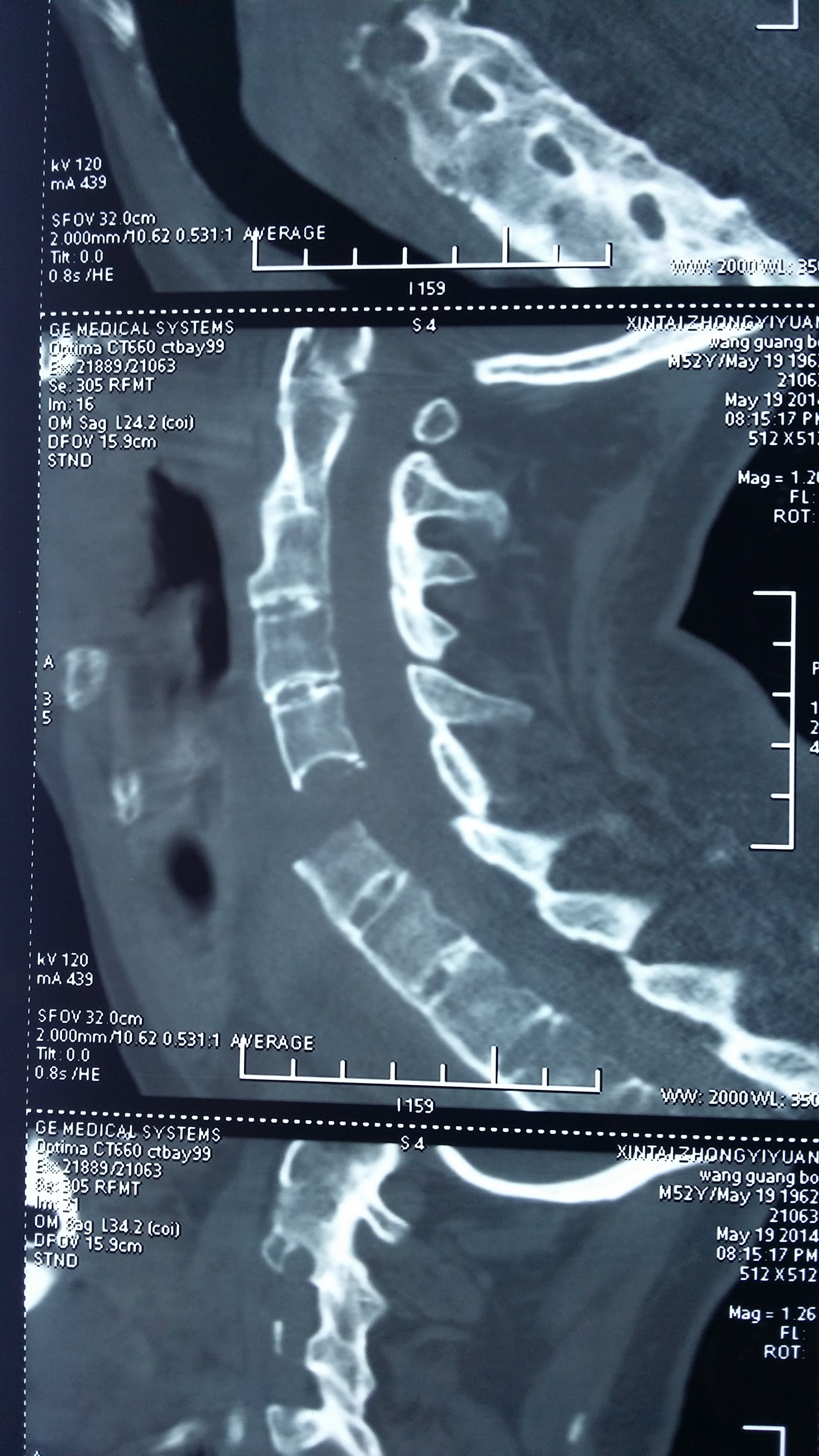 伤后即刻CT片 伤后即刻CT片