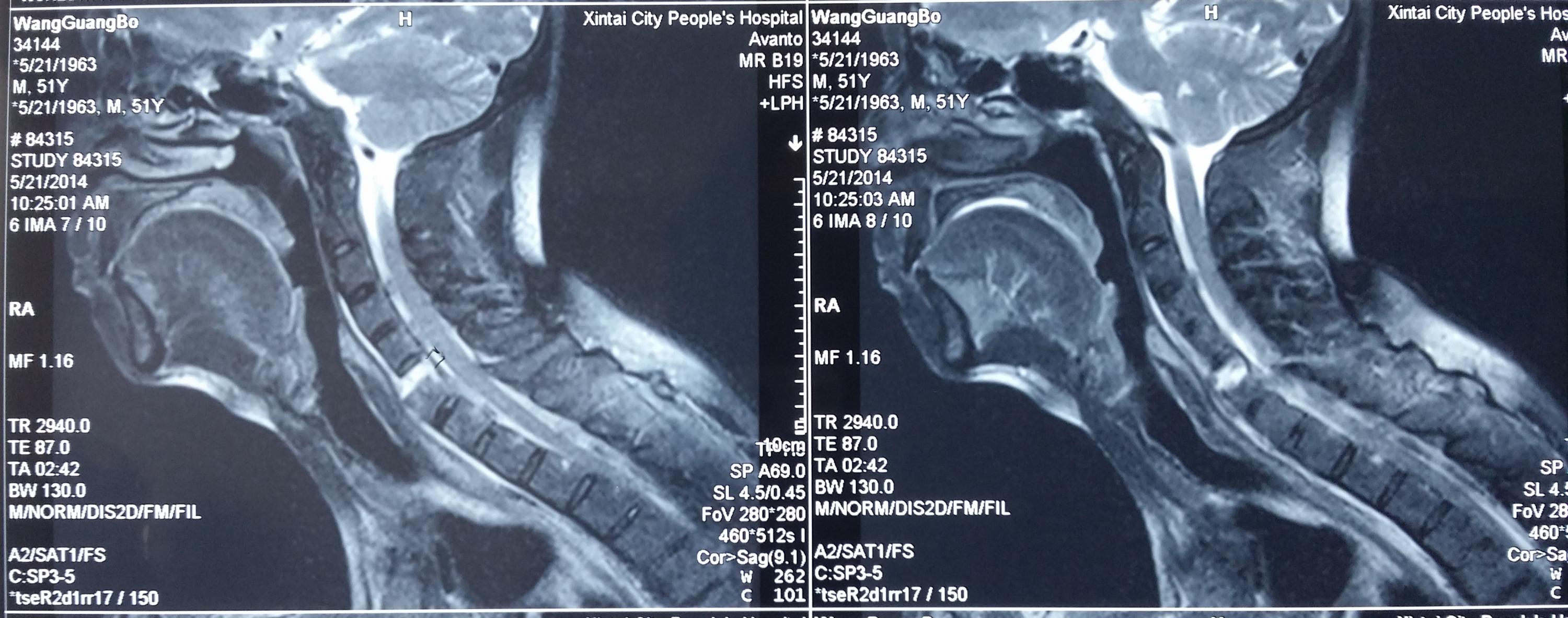 颈托固定后MRI片 颈托固定后MRI片