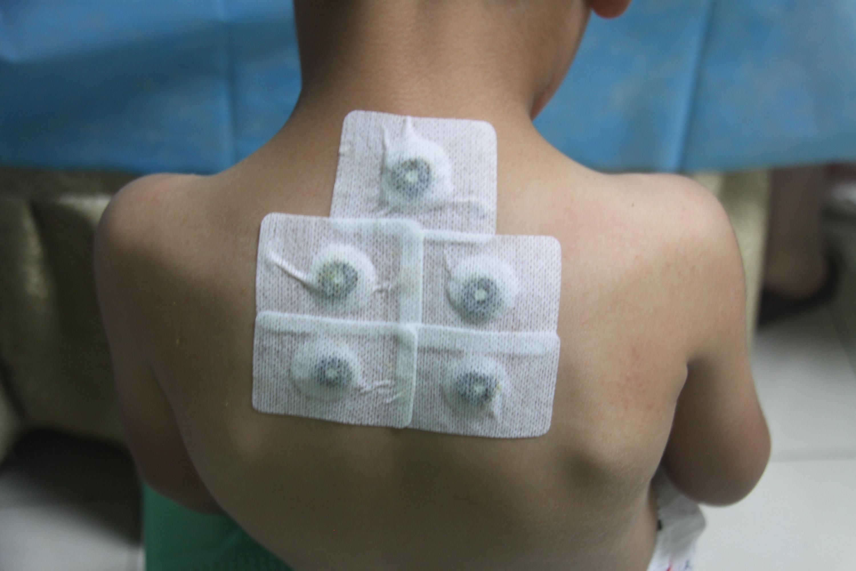 背部穴位帖敷 背部穴位帖敷